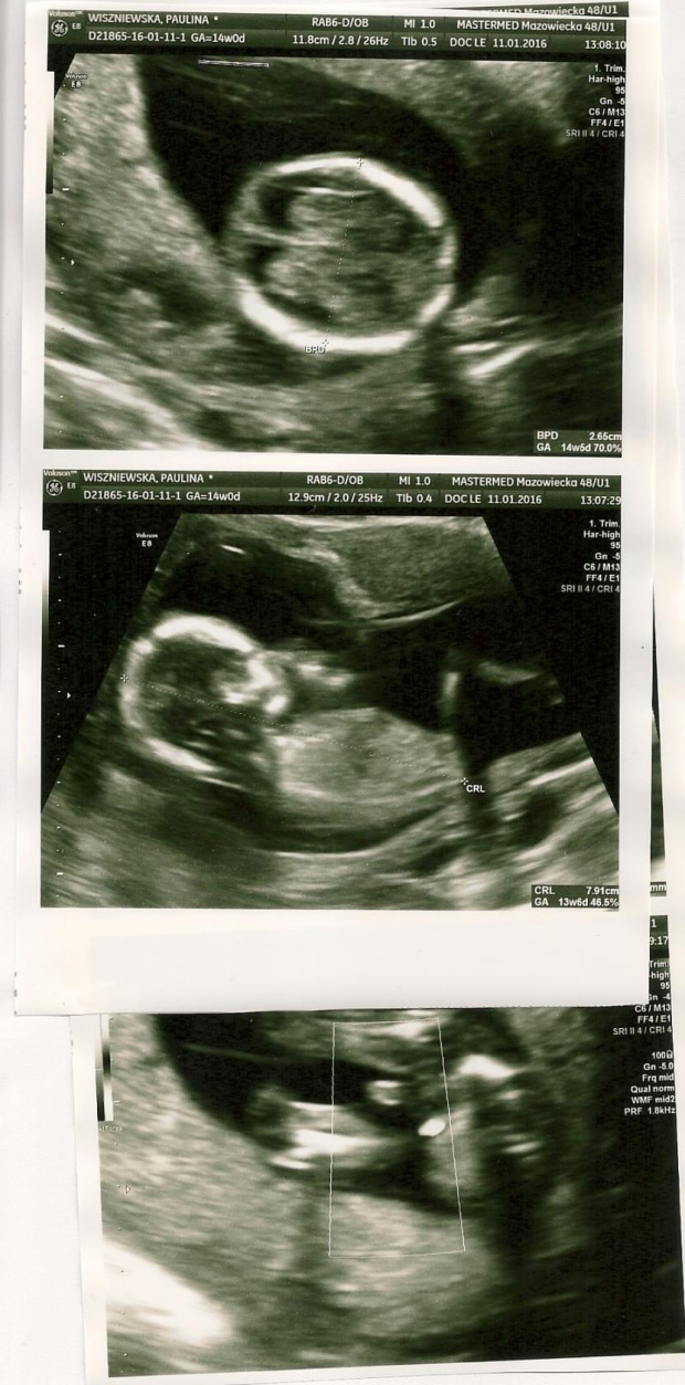 dzidzia 14t0dni prenatalne